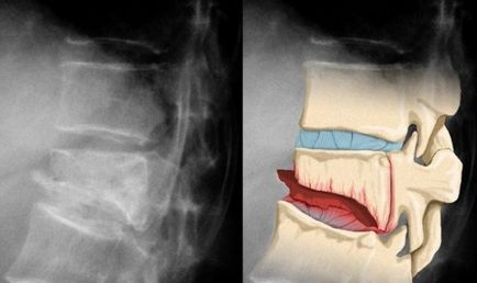 Fractura coloanei vertebrale, simptome, prim ajutor, consecințe și tratament