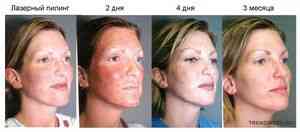 Peeling szembenézni a következményekkel - masszázs - cikkek Directory - hogyan lehet szép (peeling) Peeling szembenézni a következményekkel - masszázs - cikkek Directory - hogyan lehet szép