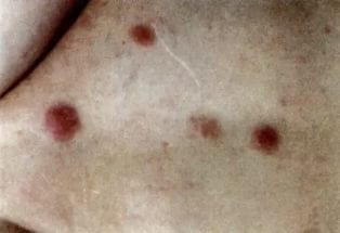 Okai melanoma okozza a betegséget, és hogyan lehet elkerülni, hogy