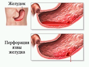 Ulcerul stomacului perforat