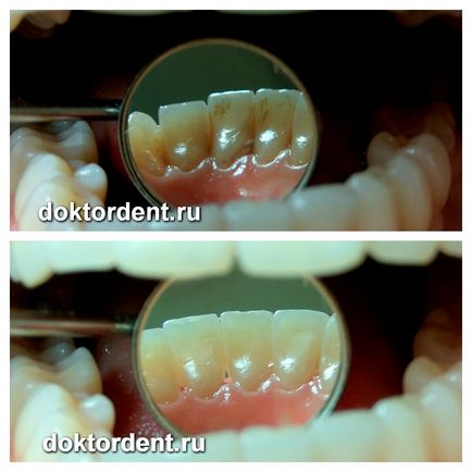 Професійне чищення зубів air flow в стоматології панацея
