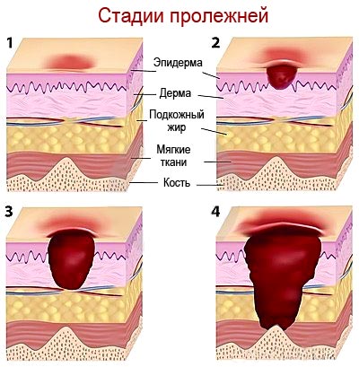 Пролежні у дітей лікування профілактика