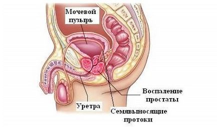 Prostatita la bărbați trăsături și consecințe ale bolii