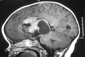 Brain cancer 4 etape - simptome, fotografii, cauze