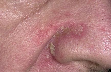 Seborrhoeás dermatitis - okok és tünetek gyermekeknél és felnőtteknél