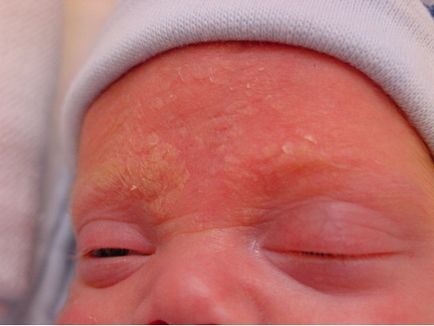 Dermatita seboreică - cauze și simptome la copii și adulți