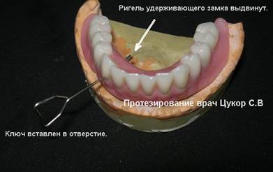 Знімні протези бувають різні! Клінічний випадок застосування знімних протезів