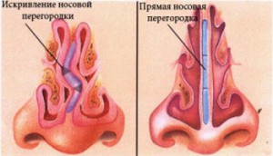 Septoplastia este o operație pe septul nasului