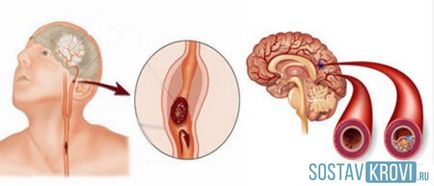 Scleroza cauzată de vasele cerebrale, simptome, diagnostic, tratament, medicamente