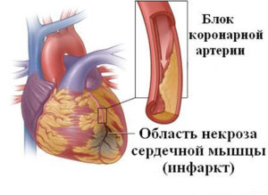 Скільки живуть після інфаркту, сенсітів