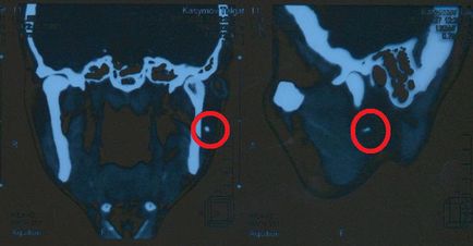 Ptyalolithiasis - tünetek és kezelés