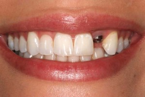 Способи протезування на імплантатах при повній відсутності зубного ряду