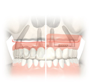 Способи протезування на імплантатах при повній відсутності зубного ряду