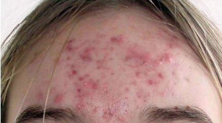 Gradele de severitate și stadii ale acneei 1, 2, 3, 4