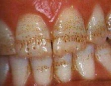 Томографія зубів опис і переваги, схема проведення