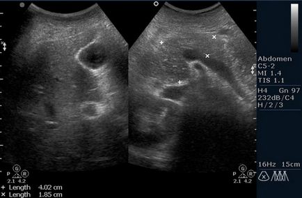 Tuberculoza abdominala si intestinala