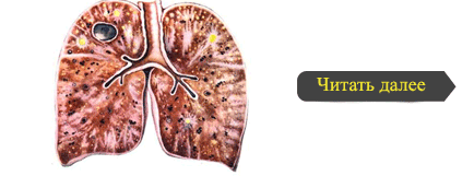 Туберкульоз лімфатичних вузлів черевної порожнини