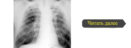 Tuberculoza ganglionilor limfatici ai cavității abdominale
