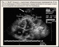 Туберкульозний перикардит - кардіогазета №01 2012 - consilium medicum