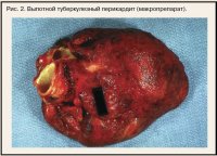 Tuberculoza pericardită - cardiogă Nr.01 2012 - consilium medicum