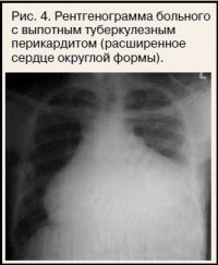 Туберкульозний перикардит - кардіогазета №01 2012 - consilium medicum
