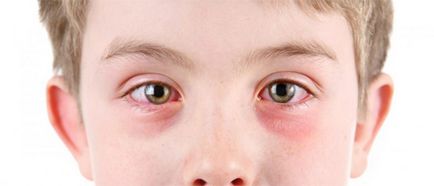 A gyermeknek vörös szemek okai és megszüntesse a problémát