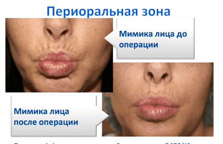 Stimularea buzelor pentru a obține proporțiile ideale și efectul de întinerire