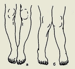 Instalații Varus și valgus de semne de stop și diferențe în diagnostic și tratament, selecție