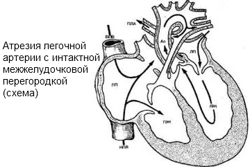 Totul despre pericolele și tratamentul atreziei pulmonare