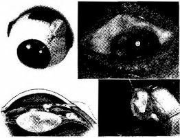 Tratamentul chirurgical al glaucomului