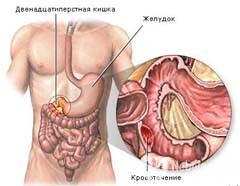 Sângerare gastrointestinală - tratament, simptome