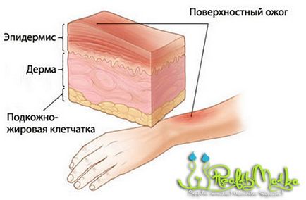 4 Ступені опіків - корисно знати!