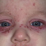 Алергічна екзема фото, причини, симптоми і лікування, спросідерматолога