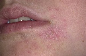 Eczemă foto alergică, cauze, simptome și tratament, adresați-vă unui dermatolog