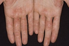 Eczemă foto alergică, cauze, simptome și tratament, adresați-vă unui dermatolog