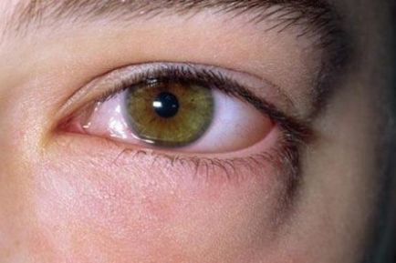 Алергія на очах як лікувати