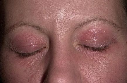 Алергія на очах як лікувати