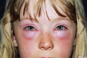 Алергія на очах, під і навколо них симптоми, причини, види, лікування