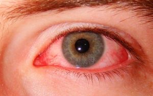 Allergia a szemet, alatt és körül tünetek, okok, típusok, kezelés