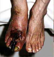 Amputarea piciorului cu gangrena la bătrânețe