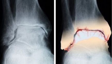 Osteoartrita simptomelor și tratamentului gleznei