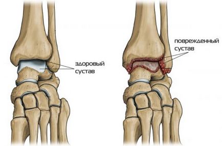 Osteoartrita simptomelor și tratamentului gleznei