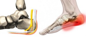 Osteoartrita tipurilor de tratament cu calcaneus