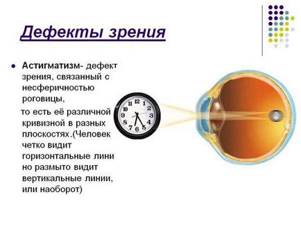 Tratamentul cu astigmatism la domiciliu fără chirurgie și chirurgical, laser, folcloric