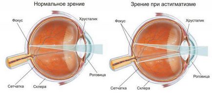 Tratamentul cu astigmatism la domiciliu fără chirurgie și chirurgical, laser, folcloric