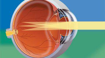 Tratamentul cu astigmatism la domiciliu fără chirurgie și chirurgical, laser, folcloric