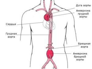 Ateroscleroza aortei abdominale ce este, simptomele și tratamentul