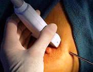 Biopsia mamară sub control uzi - procedura pentru