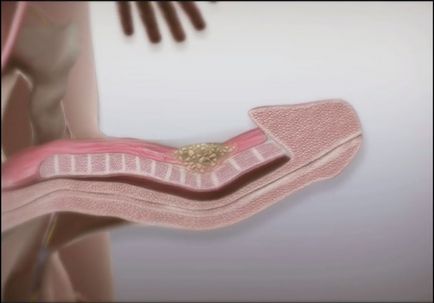 Peyronie-betegség okoz, konzervatív kezelés és a sebészet (betegség) Peyronie betegség okait, a konzervatív kezelés és a műtét