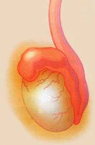 Болі в мошонці причини, ниючий біль під мошонкою і що робити якщо біль в мошонці у хлопчика